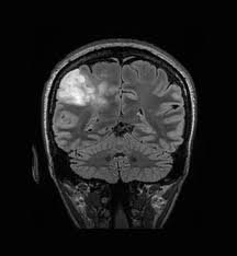 Glioblastoma Multiforme Adult Malignant Glioma Therapeutics Market 